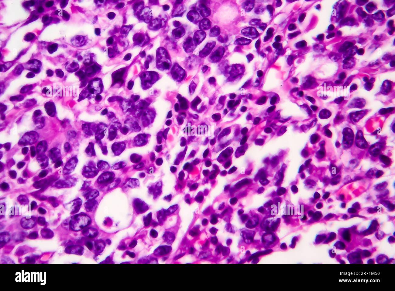 Gastric adenocarcinoma, light micrograph, photo under microscope. High ...