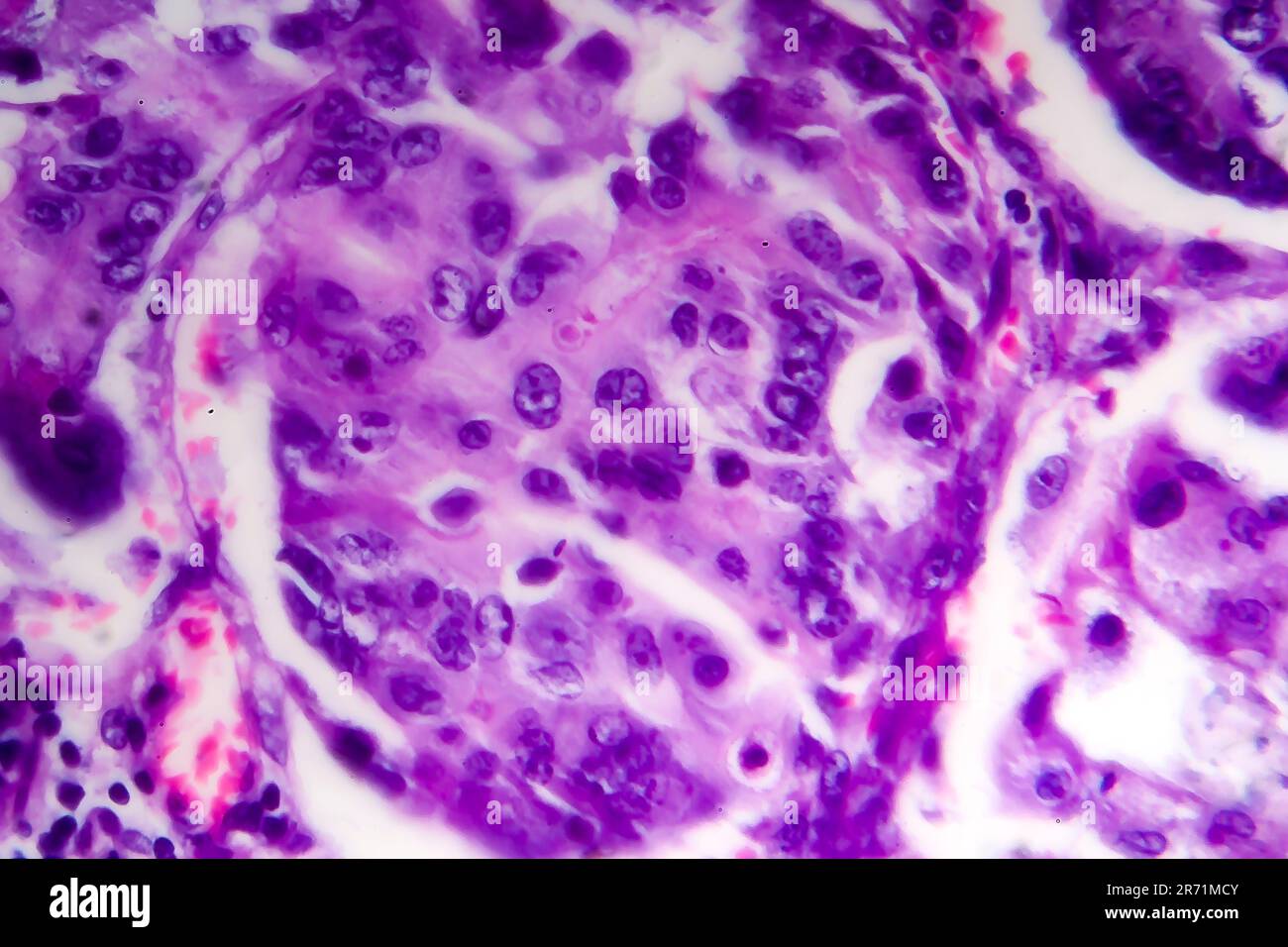 Poorly differentiated intestinal adenocarcinoma, light micrograph ...