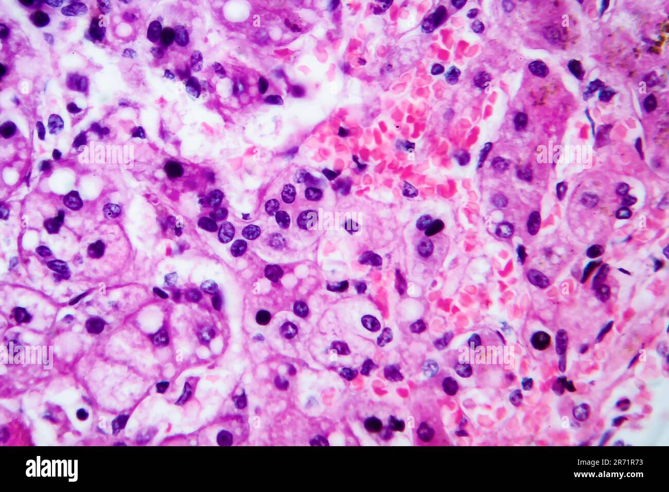 Small nodular cirrhosis, light micrograph, photo under microscope Stock ...