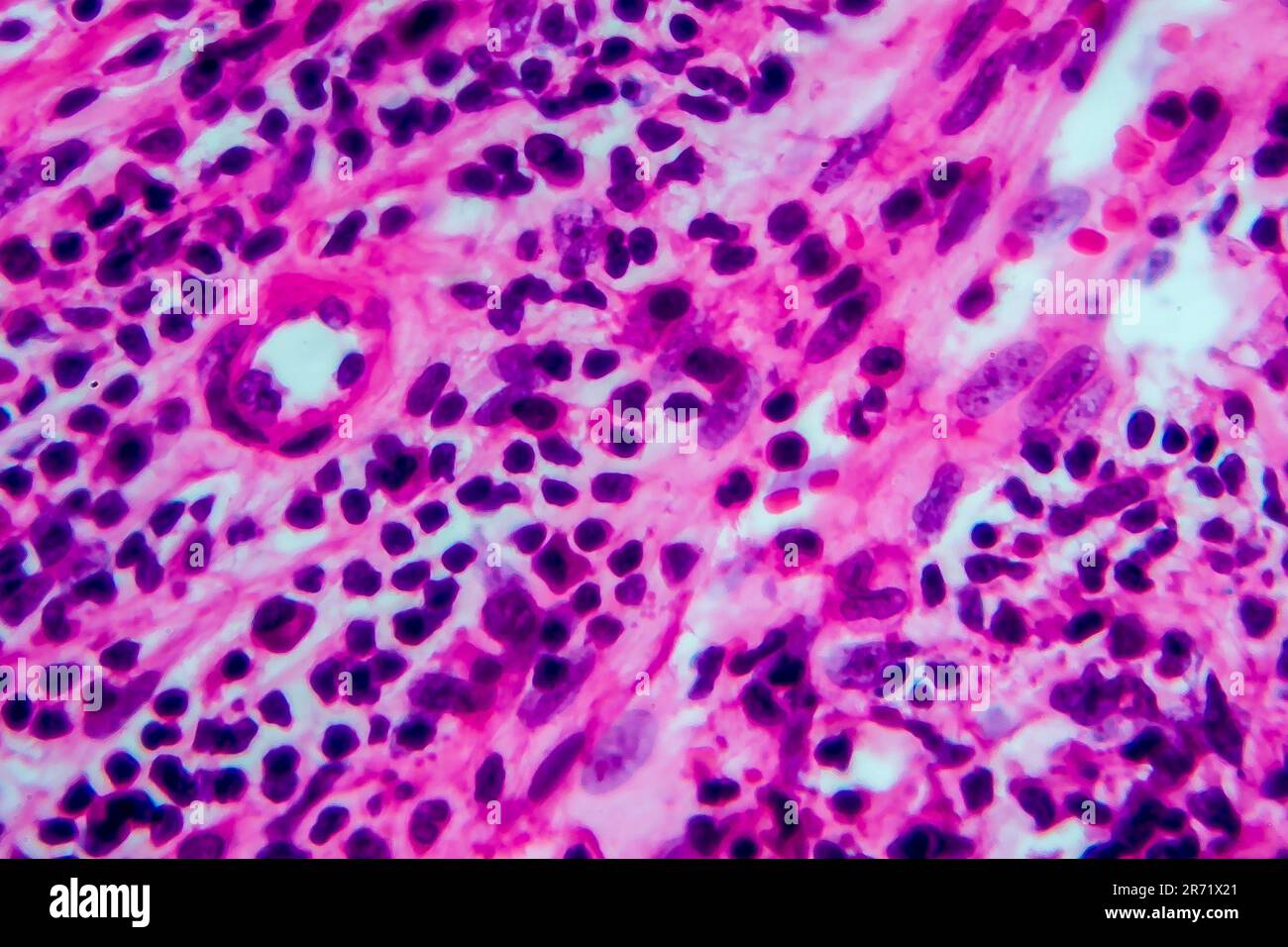 Hodgkin's lymphoma, light micrograph, photo under microscope. High magnification Stock Photo