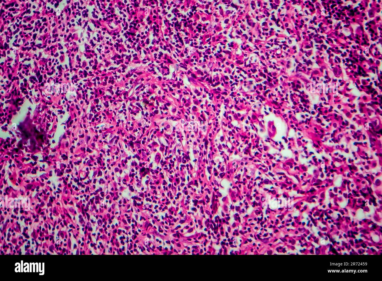 Hodgkin's lymphoma, light micrograph, photo under microscope Stock Photo