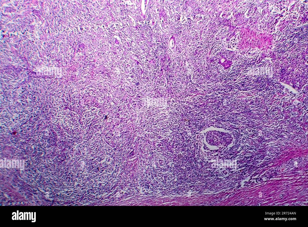 Hodgkin's lymphoma, light micrograph, photo under microscope Stock ...