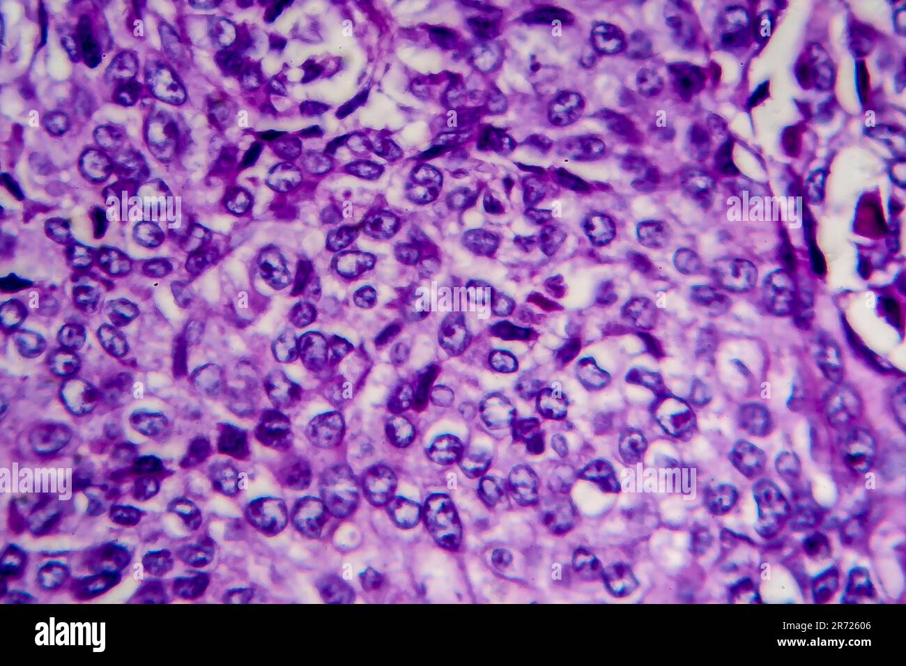 Bladder transitional cell carcinoma, light micrograph, photo under