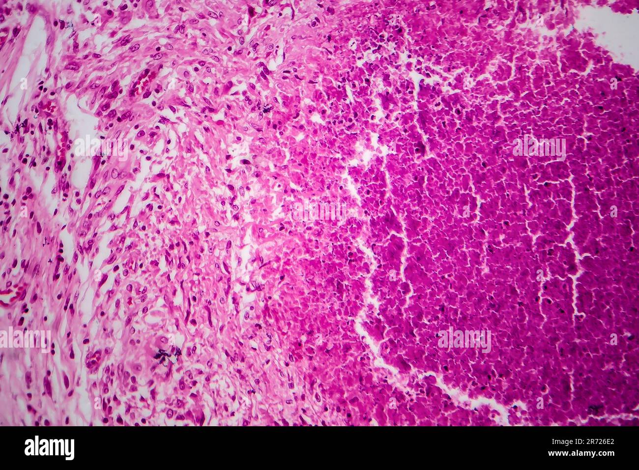 Renal tuberculosis, light micrograph, photo under microscope Stock ...