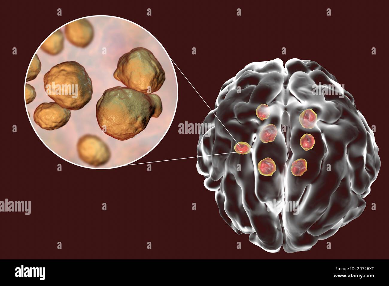 Multiple brain parenchyma lesions caused by fungus Cryptococcus neoformans, illustration. C. neoformans is a yeast- like organism. Cryptococcosis is a Stock Photo