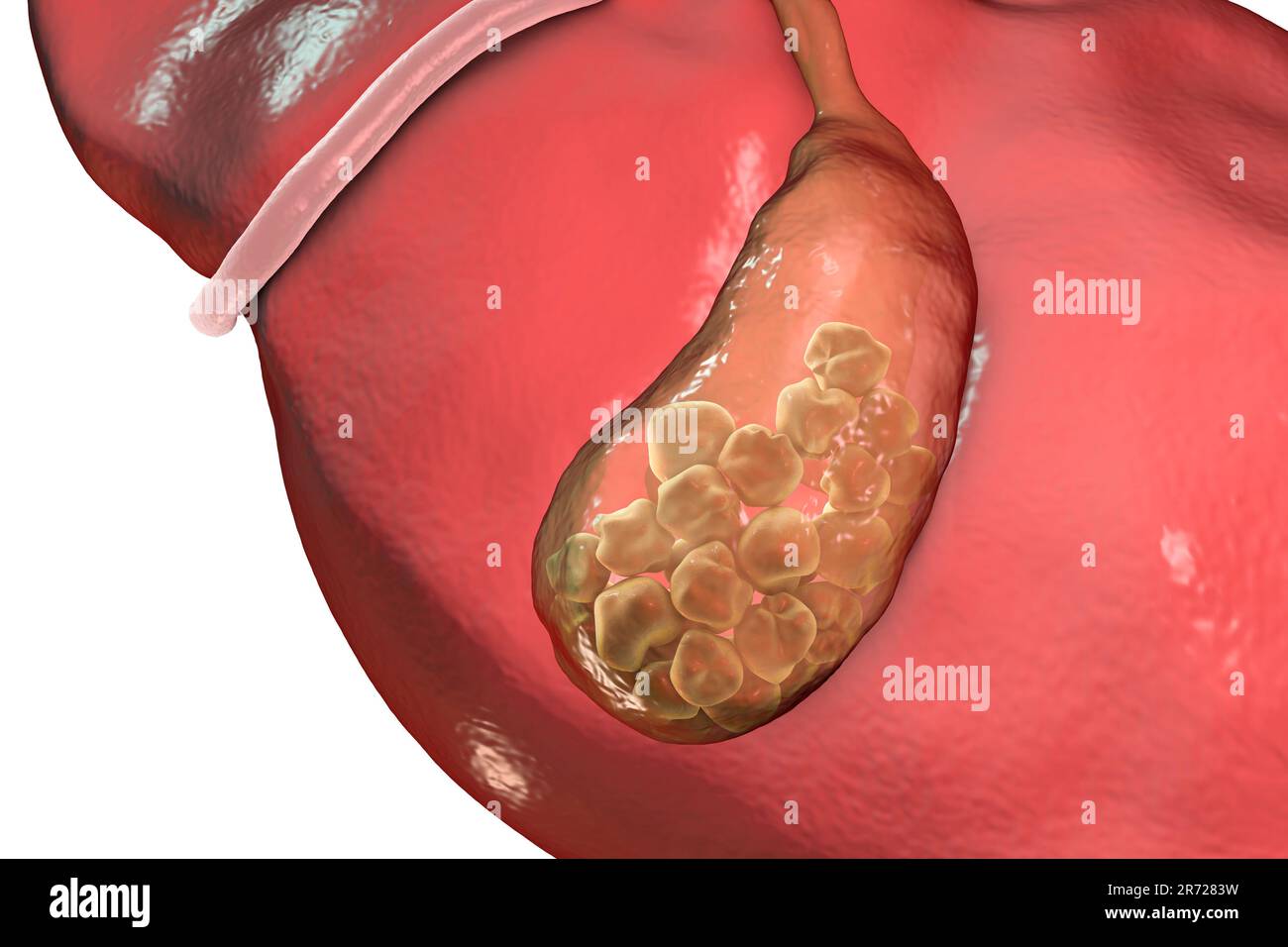 Gallstones. Artwork showing the liver and gallbladder with gallstones