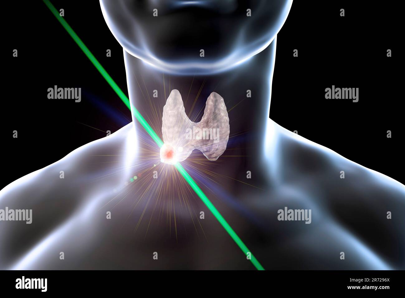Destruction of thyroid tumor, computer illustration. Conceptual image for thyroid nodules and