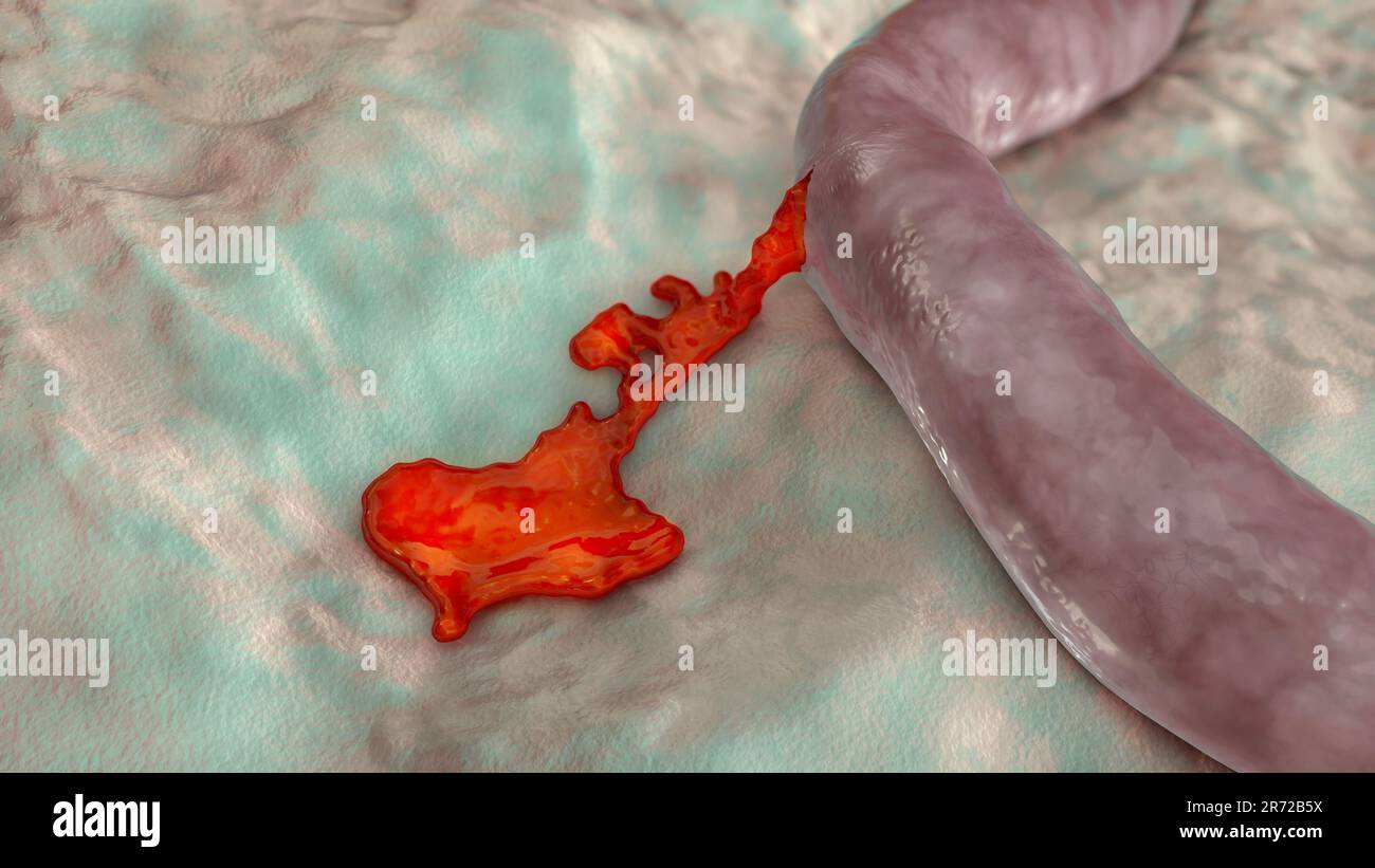 Hemorrhage, blood flowing from the damaged blood vessel, 3D