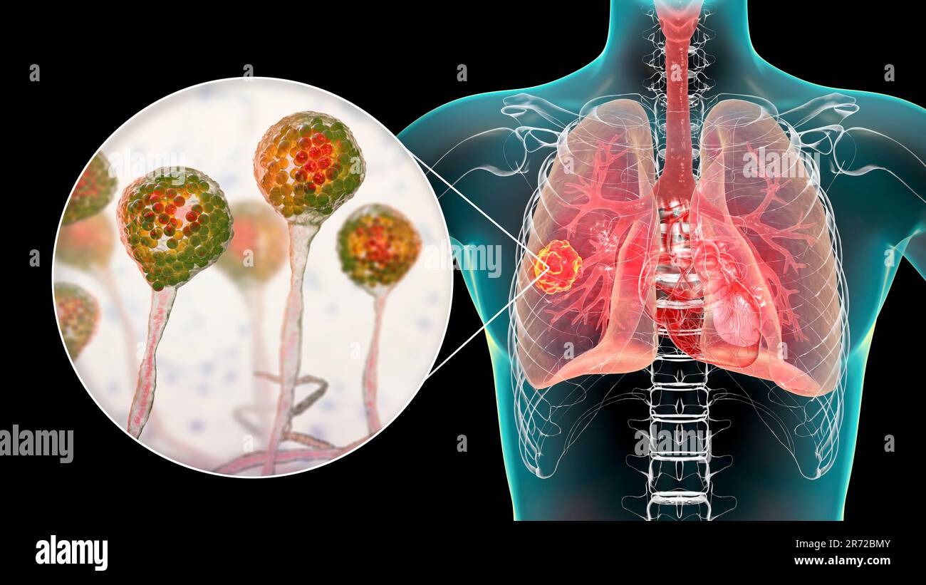 Pulmonary mucormycosis (or zygomycosis), a lung disease caused by fungi