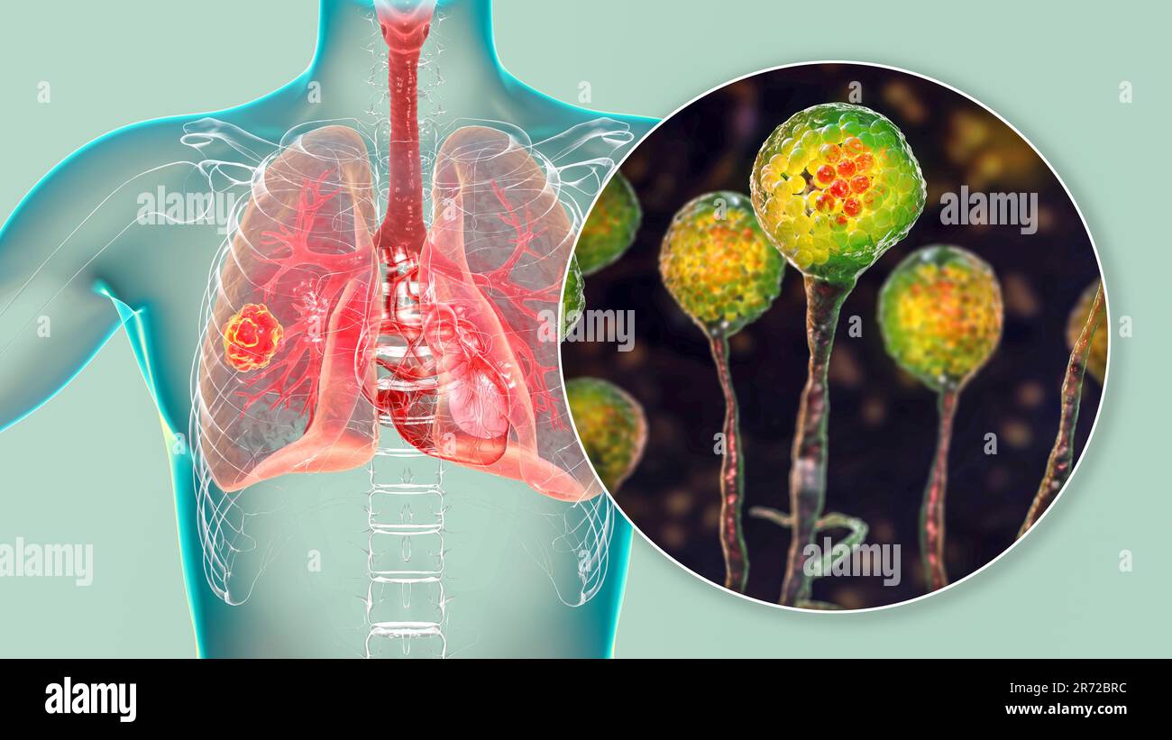 Pulmonary mucormycosis (or zygomycosis), a lung disease caused by fungi
