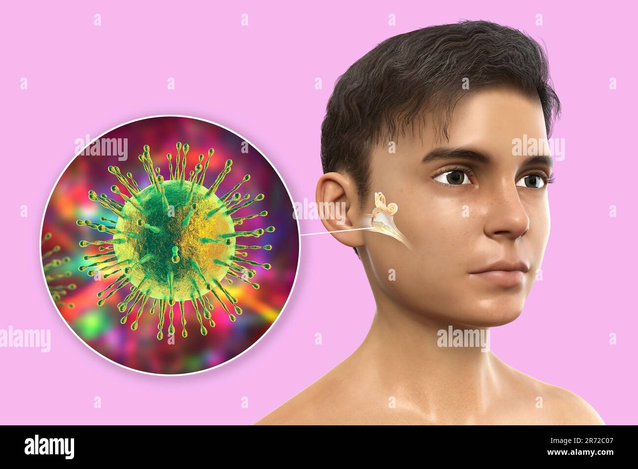 Viral otitis media, a group of inflammatory diseases of the middle ear. Computer illustration showing a boy with highlighted structures of inflamed mi Stock Photo