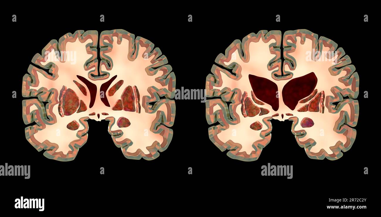 Coronal sections of a healthy brain and a brain in Huntington's disease