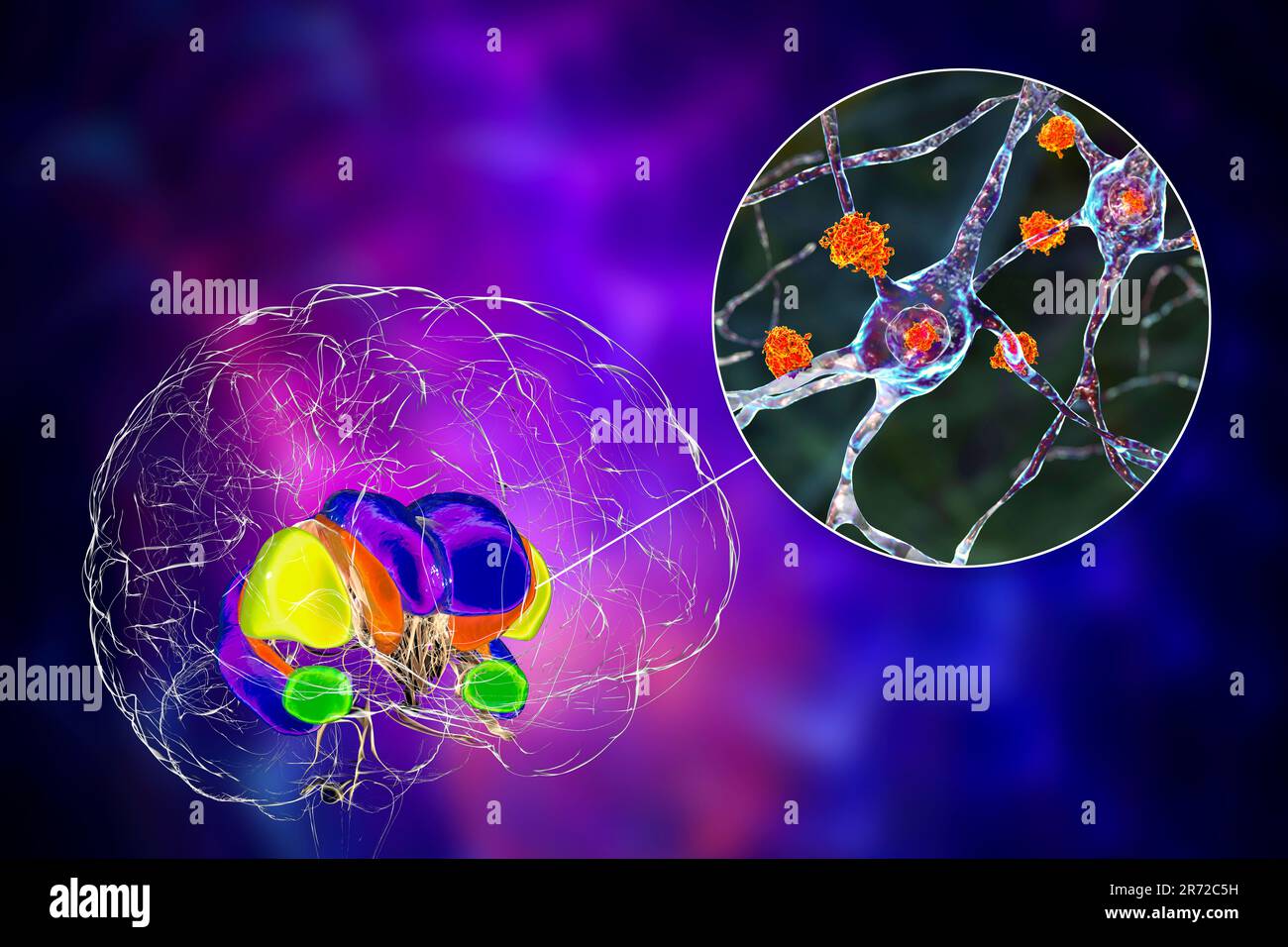 Dorsal striatum and its neurons in the Huntington's disease, computer illustration showing enlarged anterior horns of lateral ventricles, degeneration Stock Photo