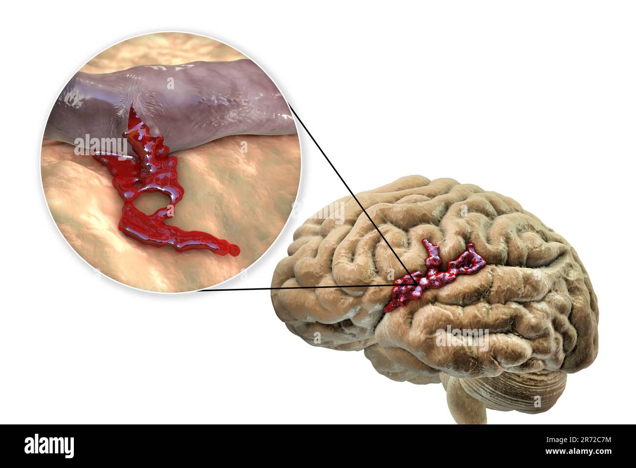 Vein Explodes Can You Die From Ruptured Blood Vessel? – YLUOZ