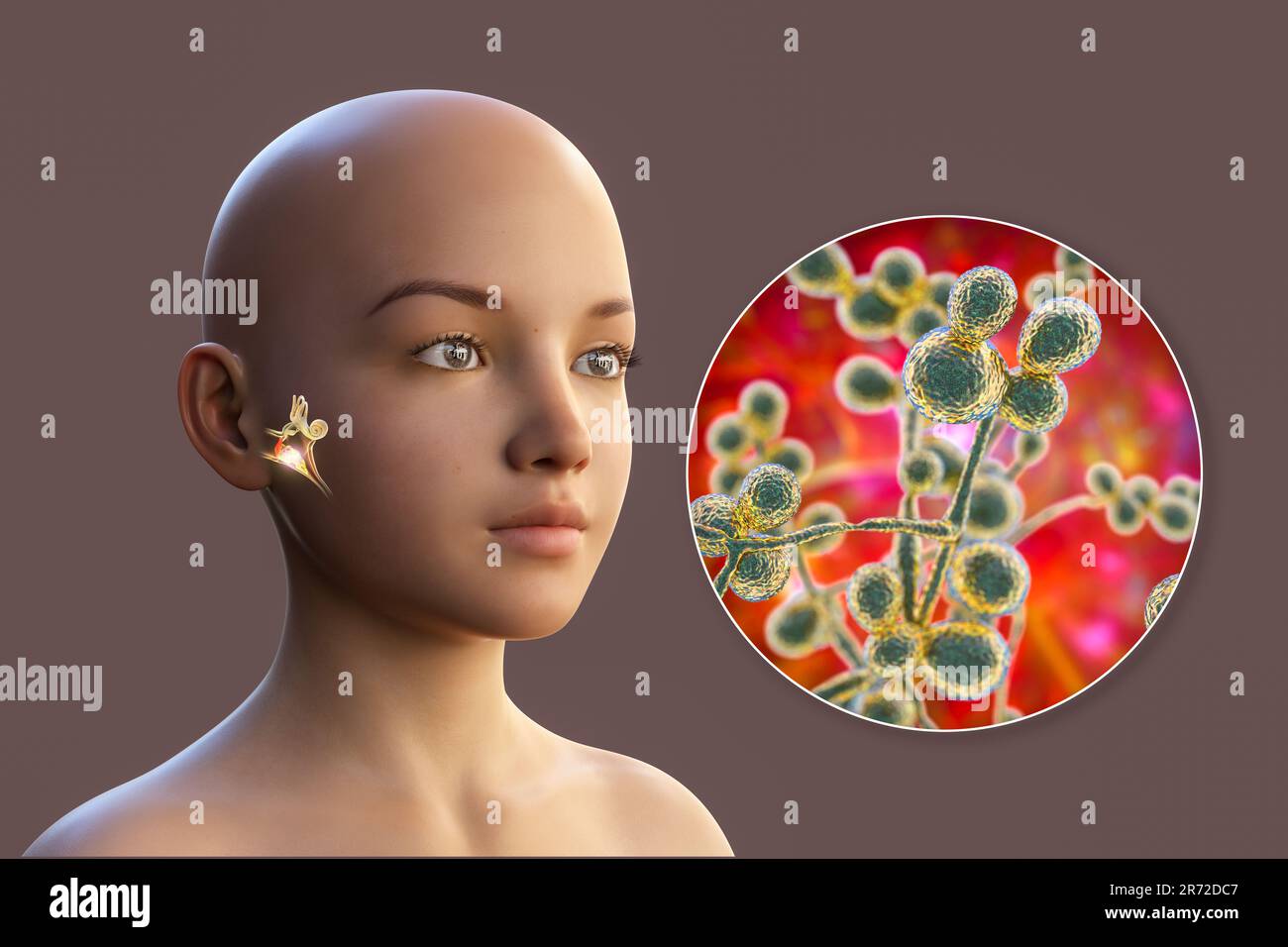 Chronic Fungal Otitis Media Ear Infection Computer Illustration