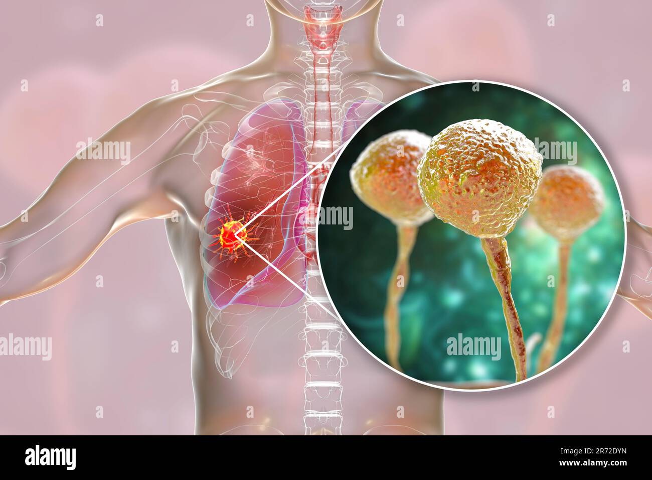 Pulmonary mucormycosis (or zygomycosis), a lung disease caused by fungi