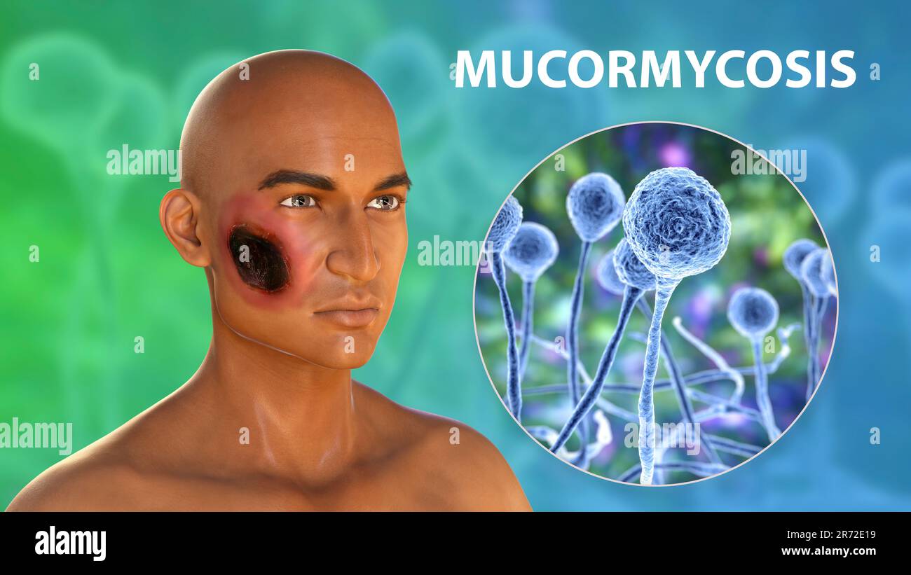 Cutaneous mucormycosis, a disease caused by Mucor fungi, computer artwork. Mucor mold is also known as black fungus, bread mold fungi. Mucor sp. fungi Stock Photo