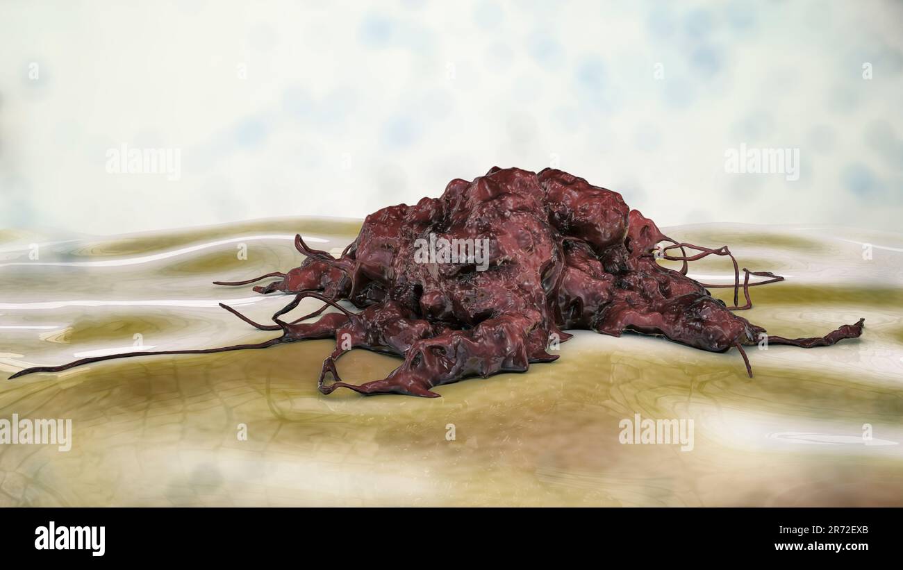 Cancer cell, computer illustration Stock Photo - Alamy
