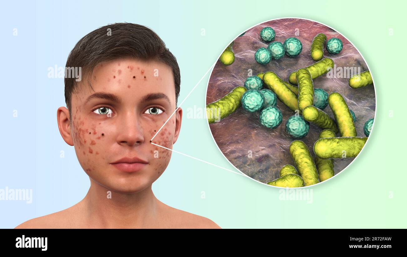 Acne vulgaris on a teenage boy's face and closeup view of bacteria
