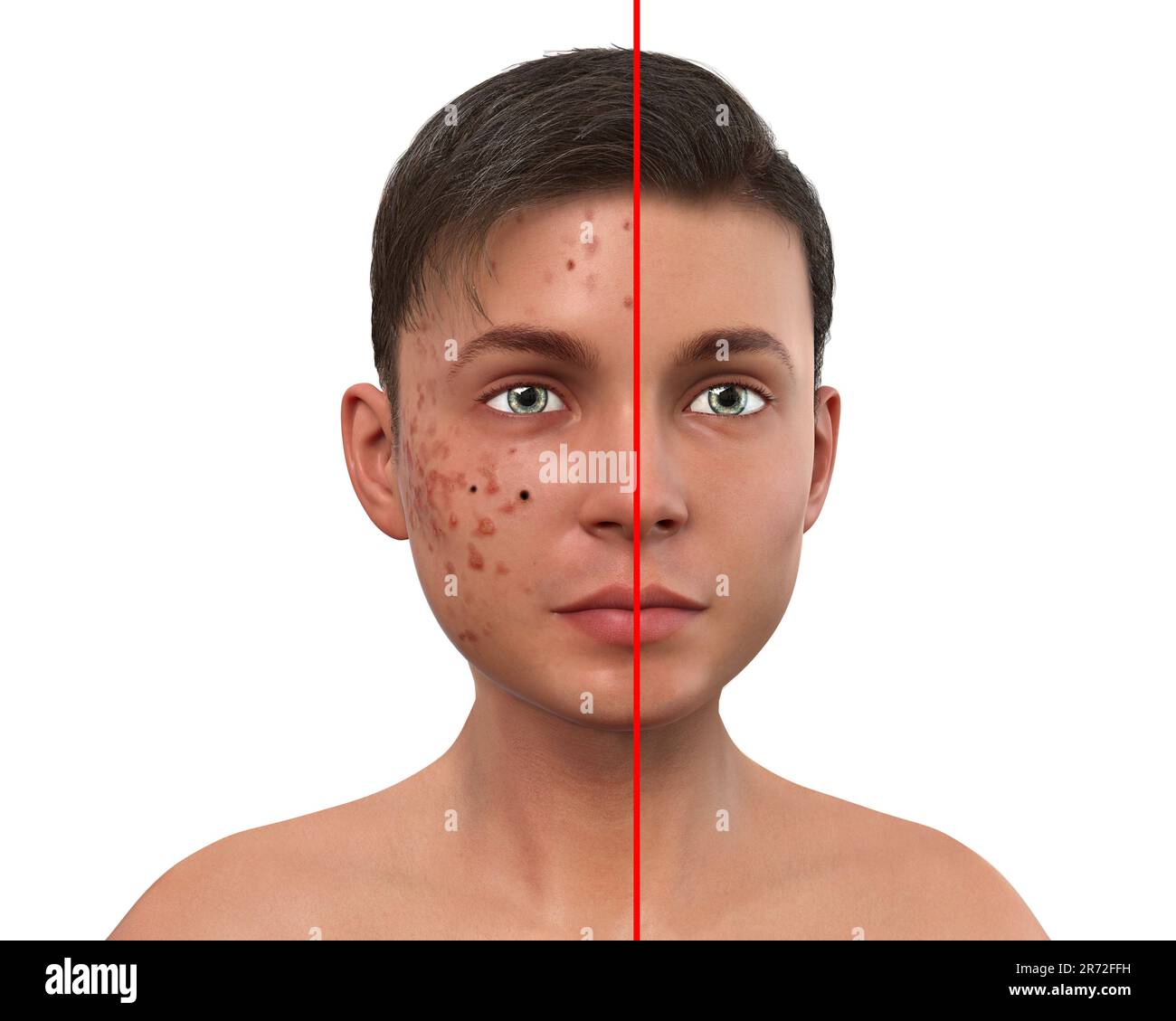 Acne vulgaris on a teenage boy's face, computer illustration showing