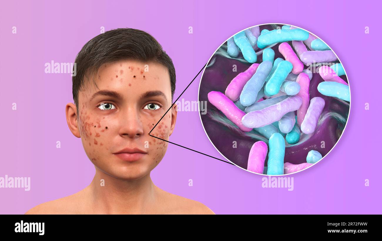 Acne vulgaris on a teenage boy's face and closeup view of bacteria