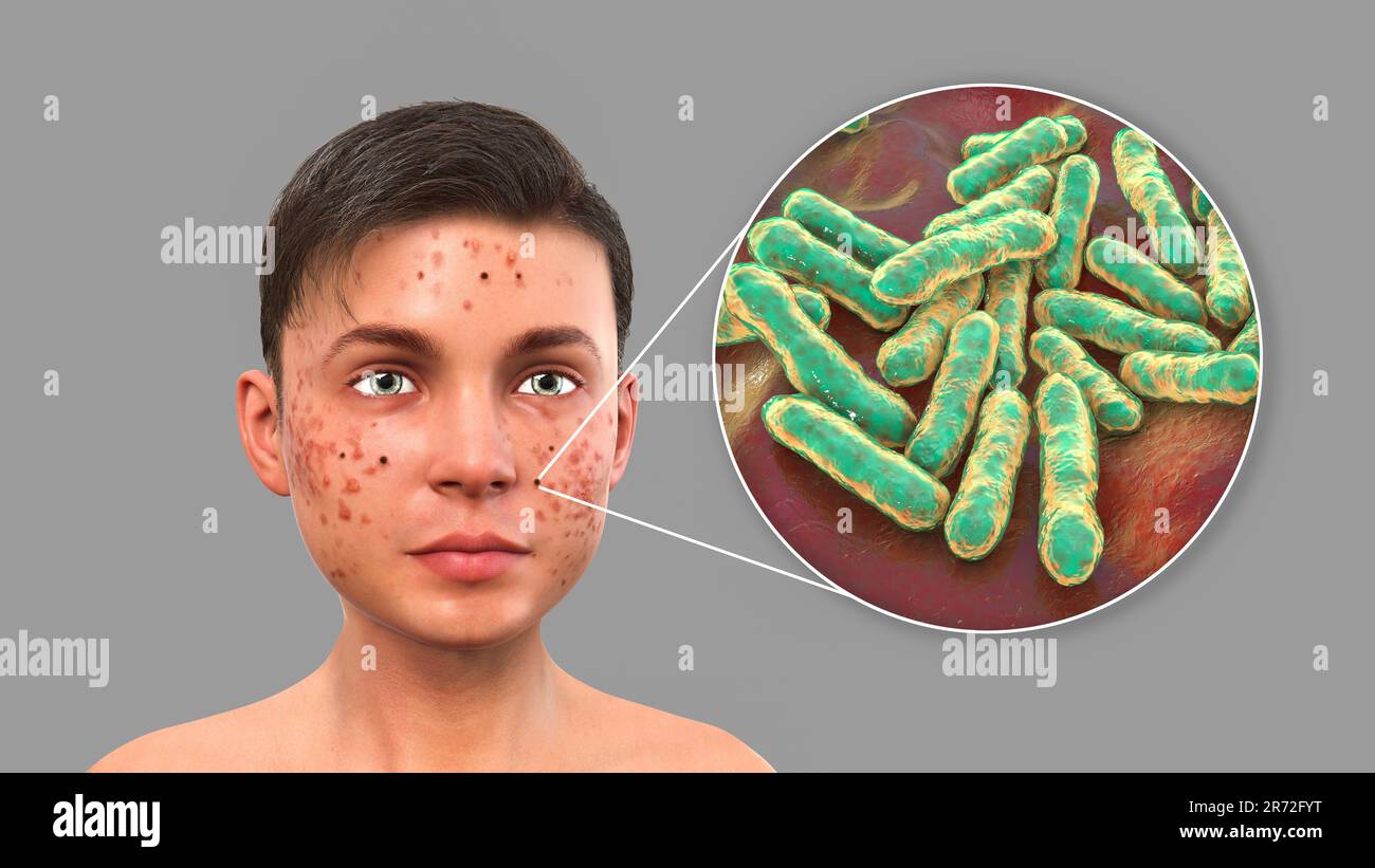 Acne vulgaris on a teenage boy's face and close-up view of bacteria ...