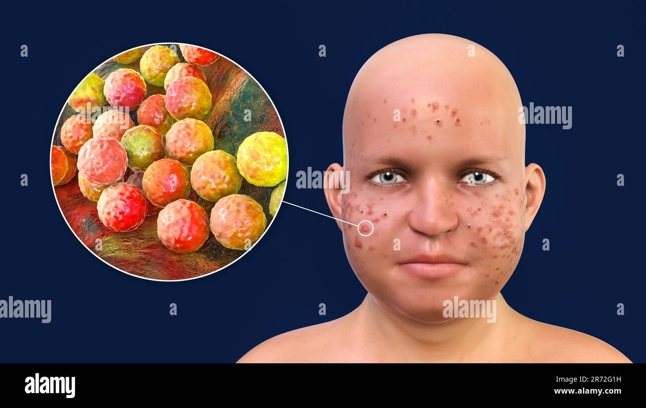 Acne vulgaris on an overweight teenage boy's face and closeup view of