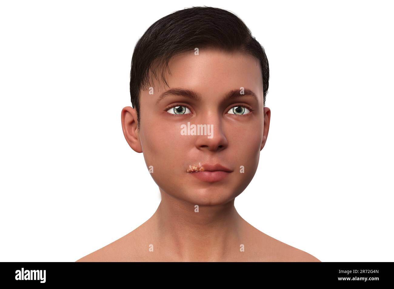Cold sore on the lip of a teenage boy, computer illustration. Cold sores are painful, fluid-filled blisters caused by infection with the herpes simple Stock Photo