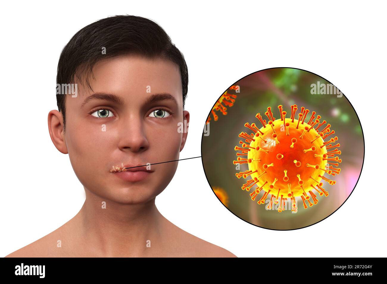Cold sore on the lip of a teenage boy and closeup view of herpes