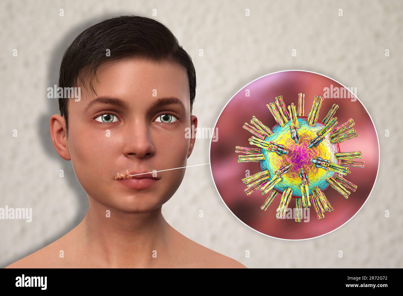 Cold sore on the lip of a teenage boy and closeup view of herpes simplex viruses, computer