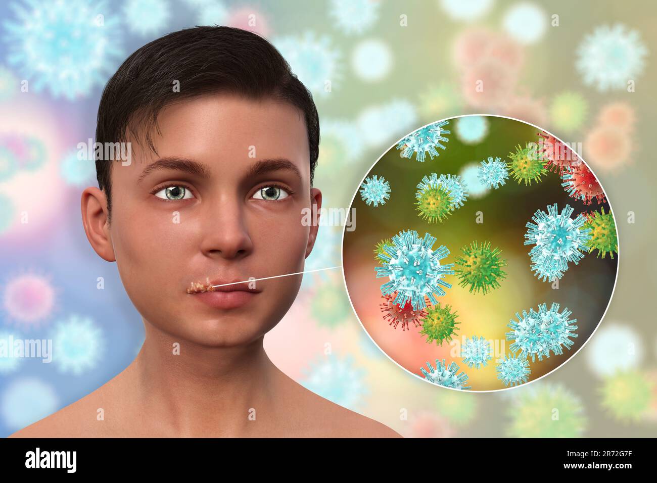 Cold sore on the lip of a teenage boy and closeup view of herpes simplex viruses, computer illustration. Cold sores are painful, fluid-filled blisters Stock Photo