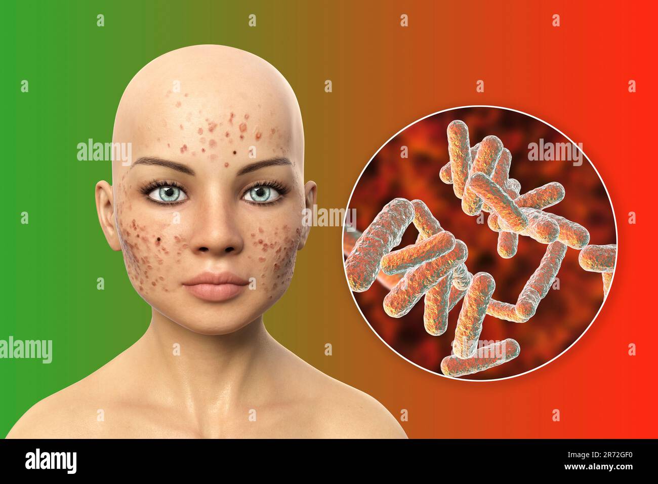 Acne vulgaris on a teenage girl's face and closeup view of bacteria