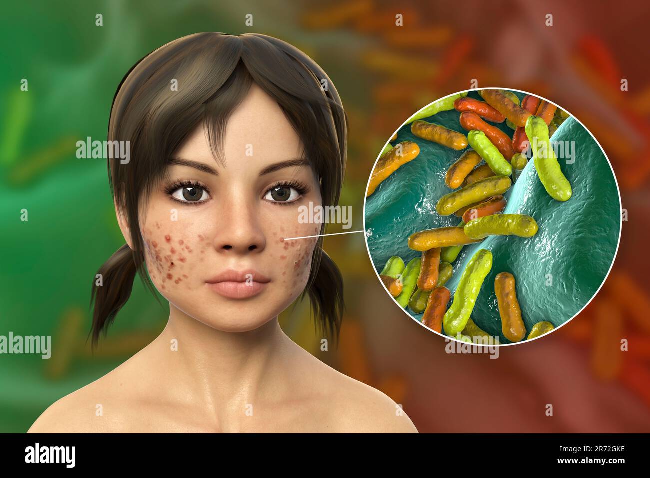 Acne vulgaris on a teenage girl's face and closeup view of bacteria