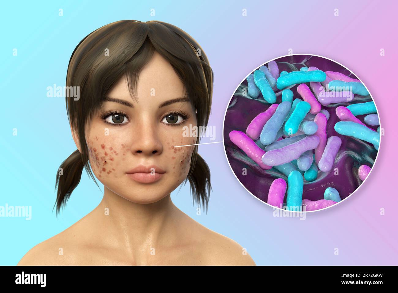 Acne vulgaris on a teenage girl's face and closeup view of bacteria