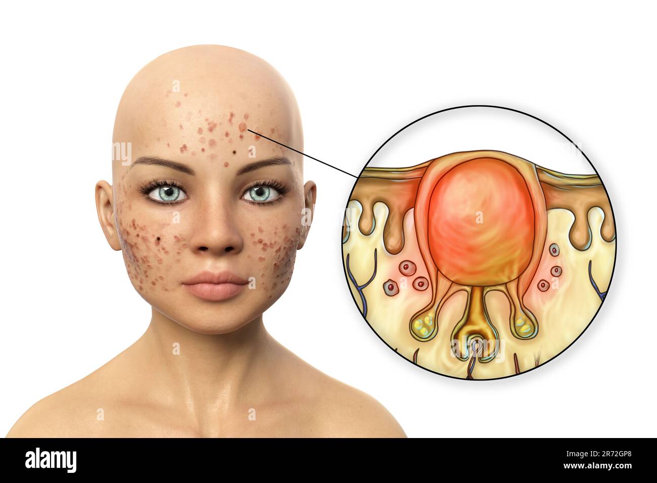 Acne vulgaris on a teenage girl's face and close-up view of black and ...