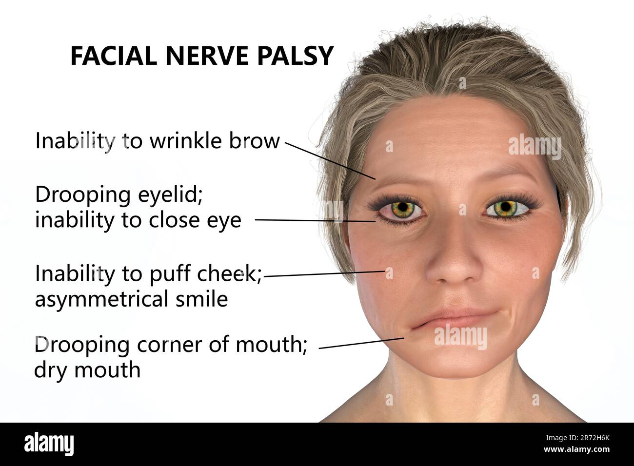 Facial Paralysis facial-paralysis