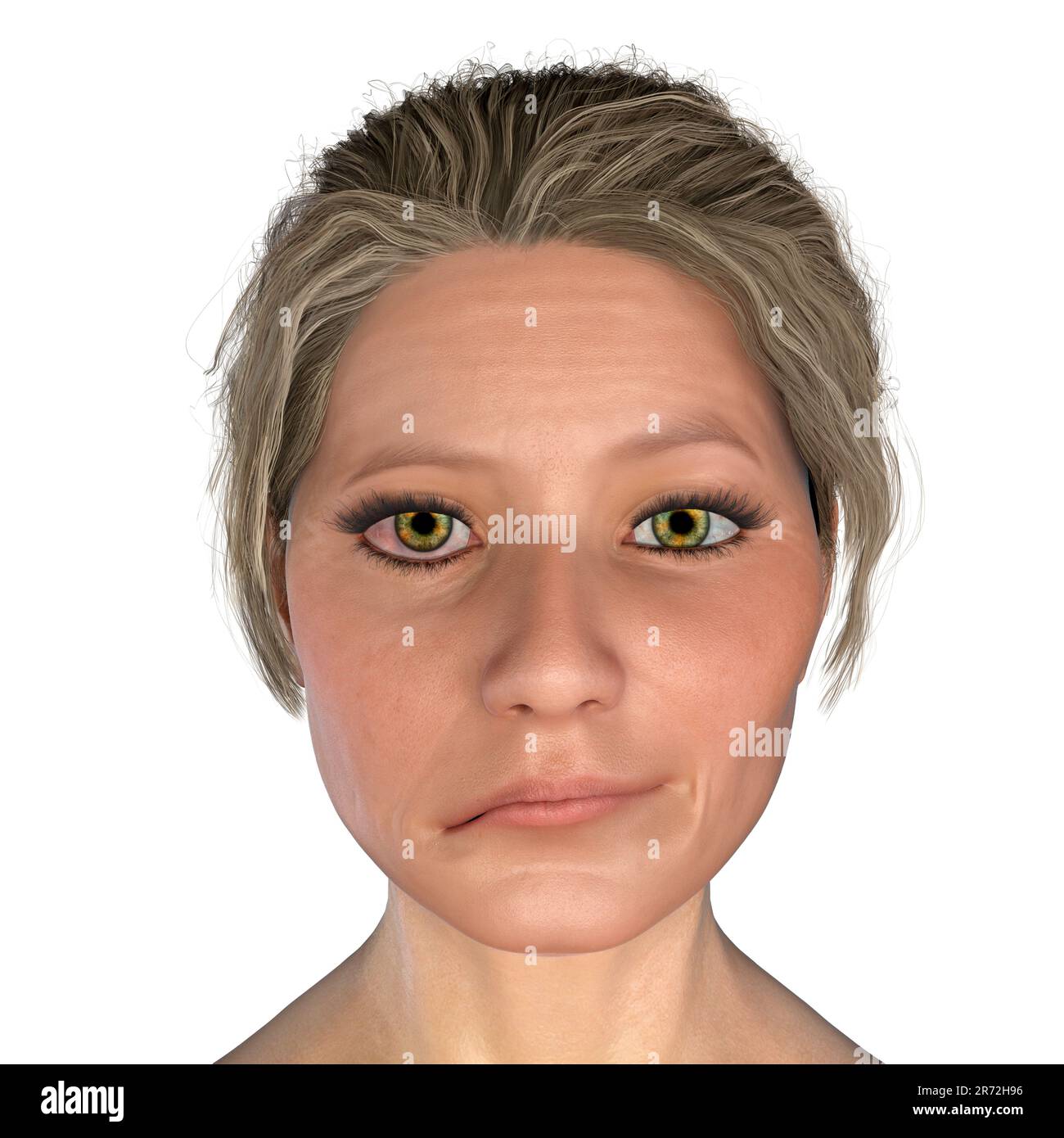 Bell's palsy, a unilateral facial paralysis, computer illustration. The condition is due to the inflammation of the facial nerve. It causes facial dro Stock Photo