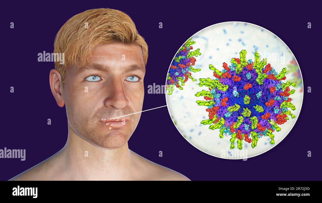 Cold sore on the lip of a man and closeup view of herpes simplex viruses, computer illustration. Cold sores are painful, fluid-filled blisters caused Stock Photo