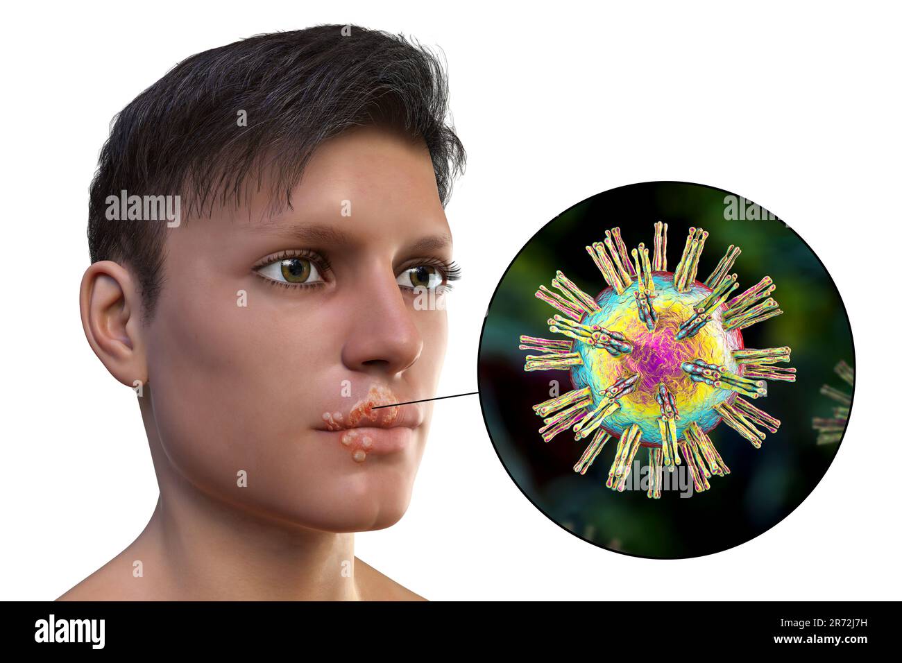 Cold sore on the lip of a man and closeup view of herpes simplex
