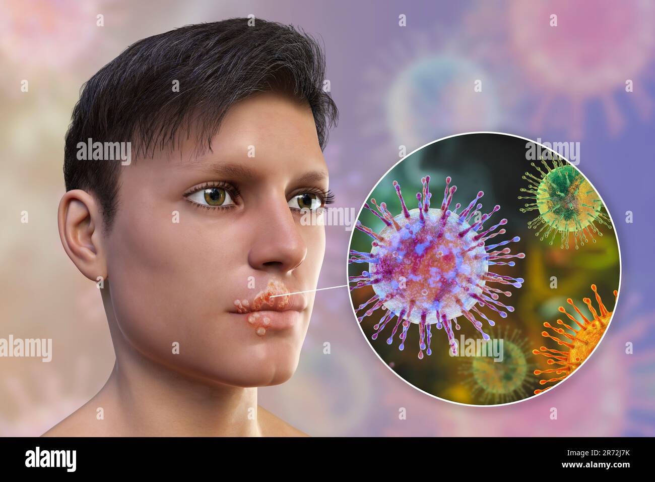 Cold sore on the lip of a man and closeup view of herpes simplex viruses, computer illustration. Cold sores are painful, fluid-filled blisters caused Stock Photo