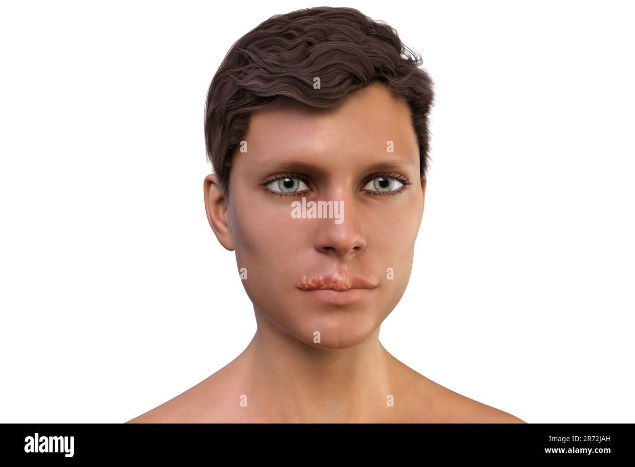 Cold sore on the lip of a man, computer illustration. Cold sores are painful, fluid-filled blisters caused by infection with the herpes simplex virus. Stock Photo
