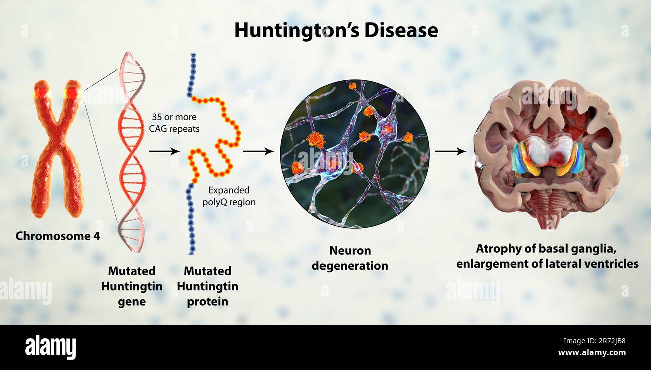 Molecular genesis of Huntington's disease, computer illustration. Expansion  of the CAG trinucleotide sequence in the htt gene causes production of mut  Stock Photo - Alamy