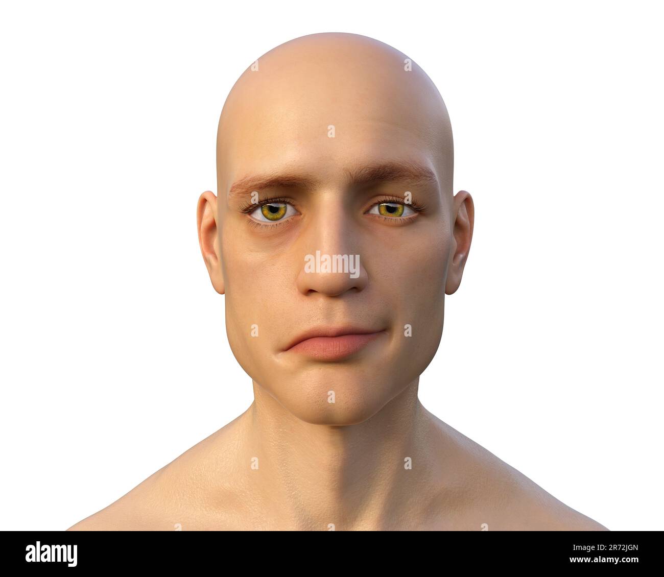 Bell's palsy, a unilateral facial paralysis, computer illustration. The