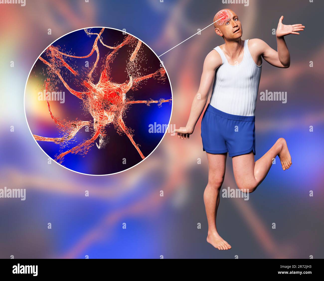 A person with chorea disease and close-up view of neuronal degradation ...