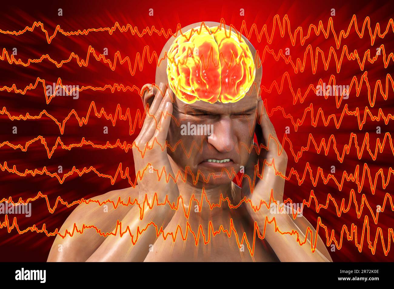 Headache, migraine, computer illustration Stock Photo - Alamy
