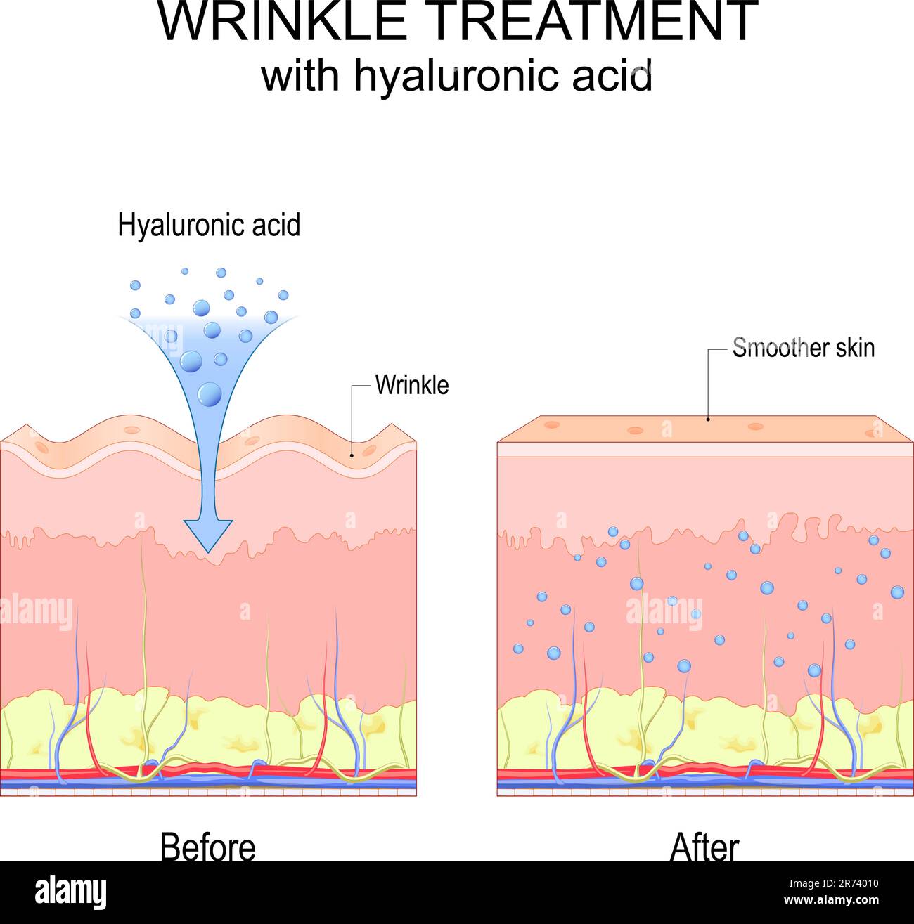 Wrinkle treatment with hyaluronic acid. Before and after procedure. Visible results. Smoother and Youthful skin. Poster for use in cosmetology, beauty Stock Vector
