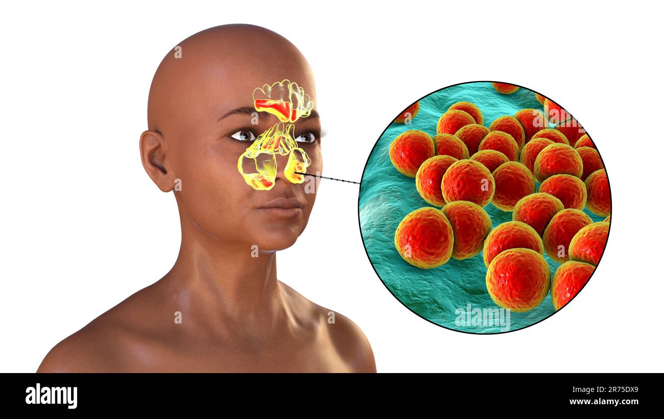 Streptococcus pneumoniae bacteria as a cause of sinusitis. Computer illustration showing inflammation of frontal, ethmoid, and maxillary sinuses and c Stock Photo