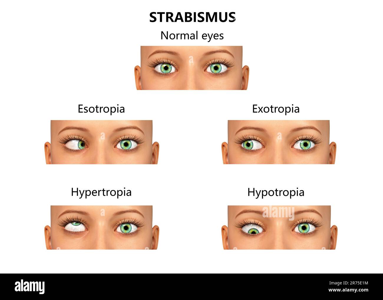 Strabismus types, computer illustration. Stock Photo