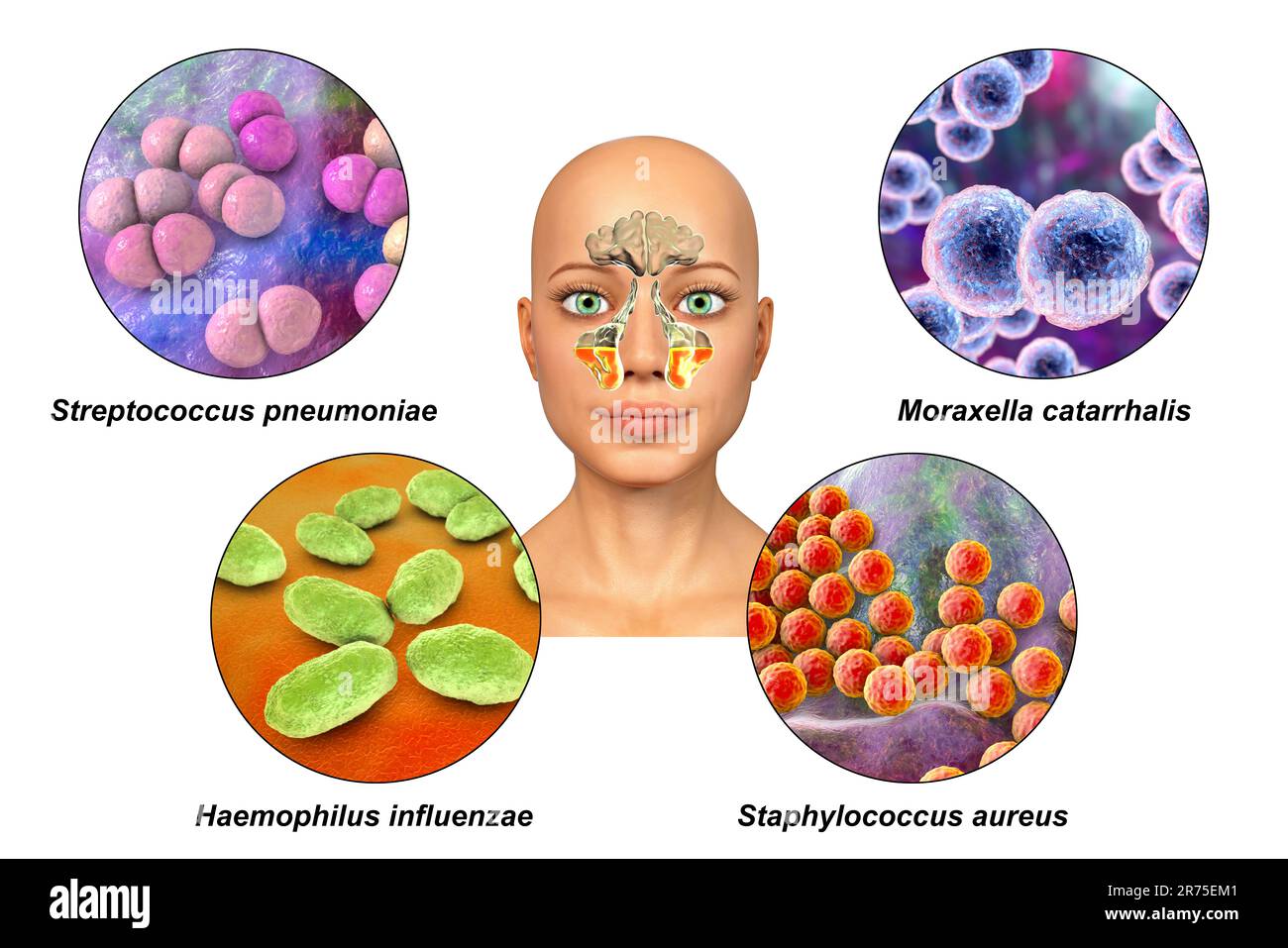 Anatomy of rhinosinusitis and bacteria that cause sinusitis. Streptococcus pneumoniae, Moraxella catarrhalis, Haemophilus influenzae, and Staphylococc Stock Photo