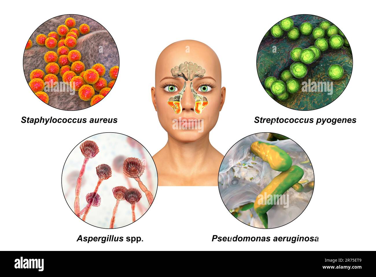 Anatomy of rhinosinusitis and microorganisms that cause sinusitis. Streptococcus pneumoniae, Streptococcus mutans, Aspergillus fumigatus, and Pseudomo Stock Photo